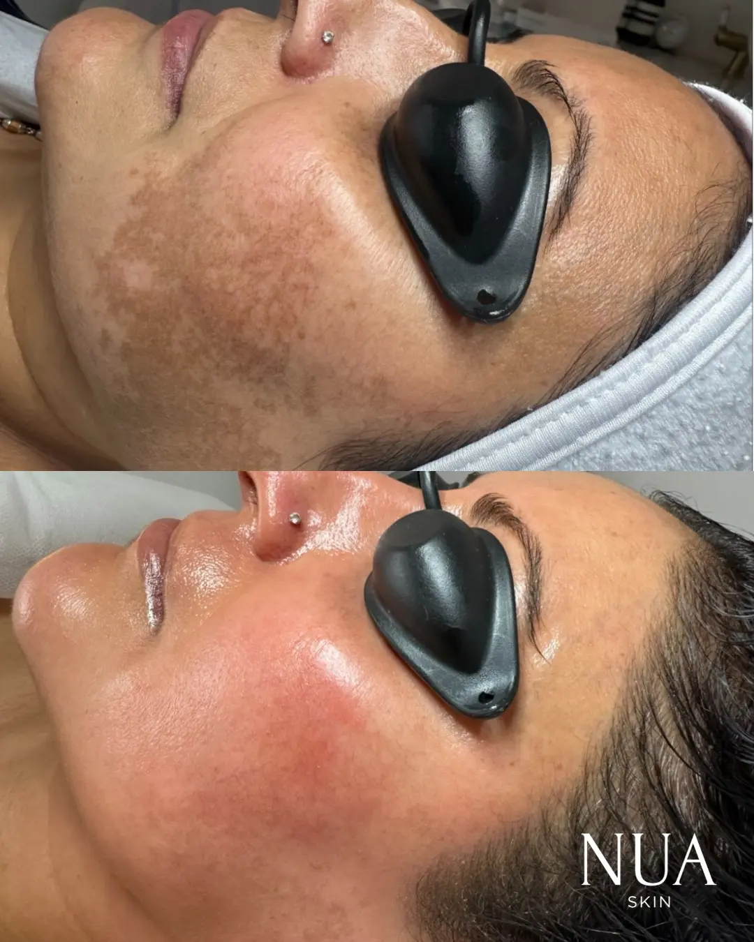 Before and after pigmentation treatment — Melasma Faded