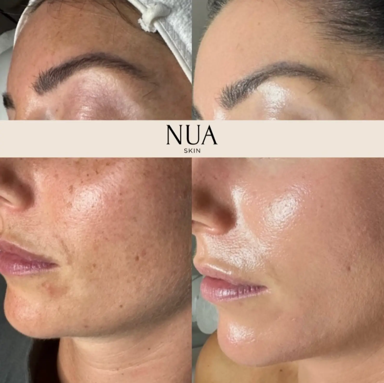 Client skin before and after treatment at Nua Skin, result 5
