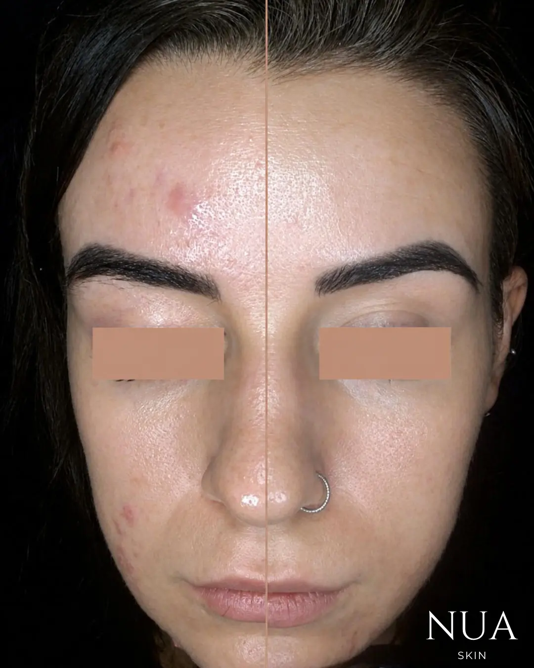Before and after pigmentation treatment — Overall Clarity Achieved