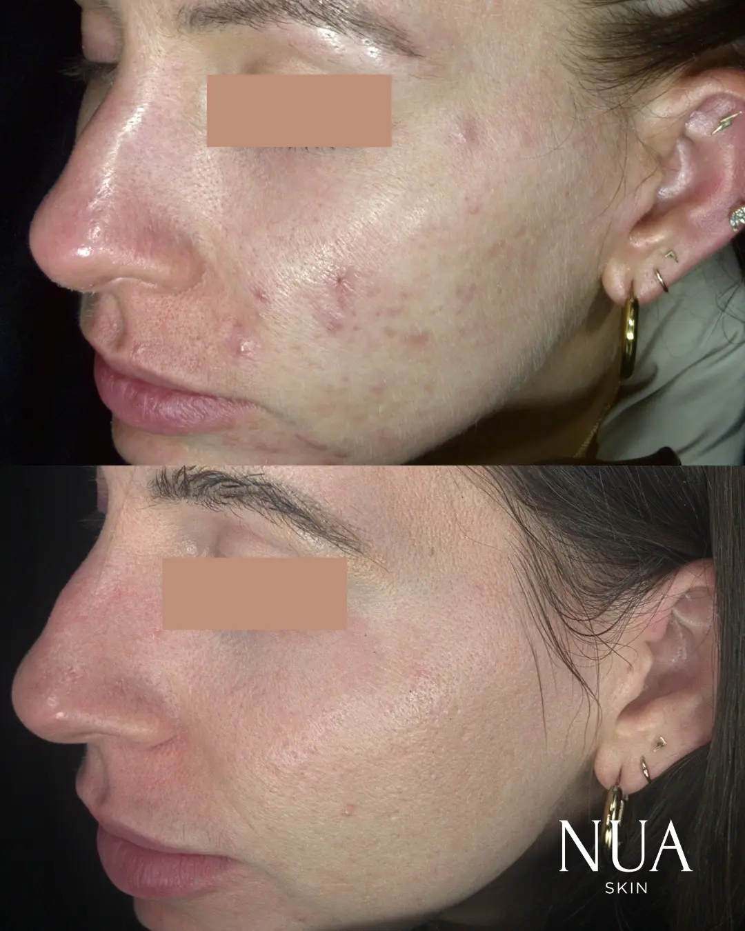 Before and after pigmentation treatment — Blotchy Patches Smoothed