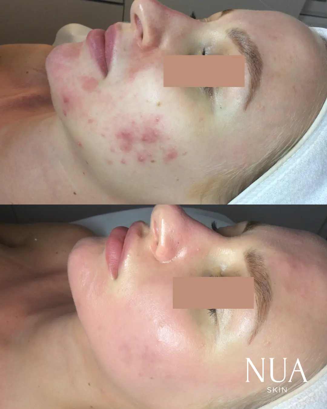 Before and after pigmentation treatment — Redness & Pigment Calmed