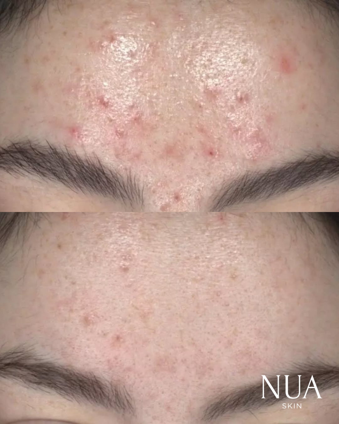 Before and after pigmentation treatment — Congestion & Marks Cleared