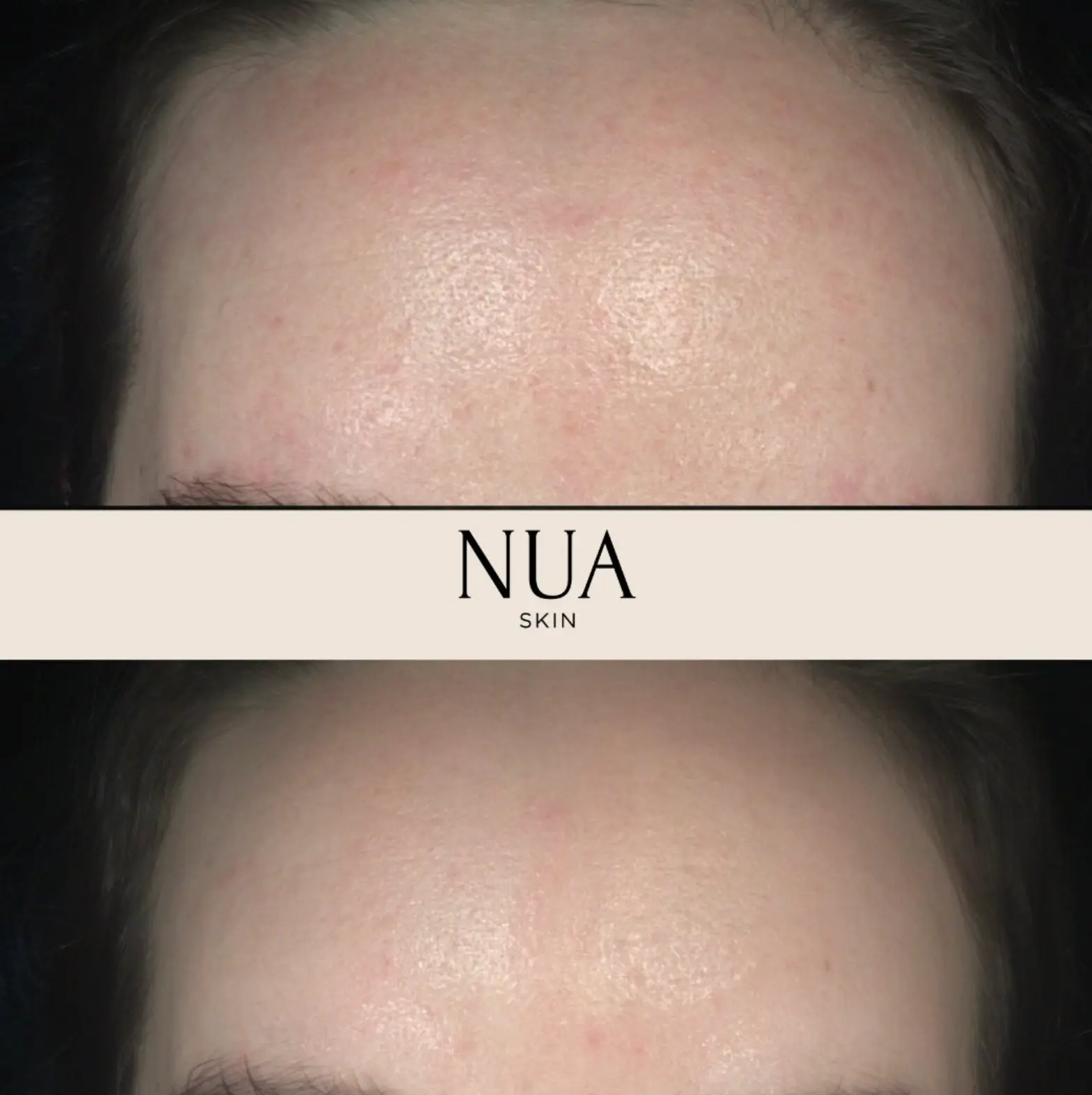 Client skin before and after treatment at Nua Skin, result 6