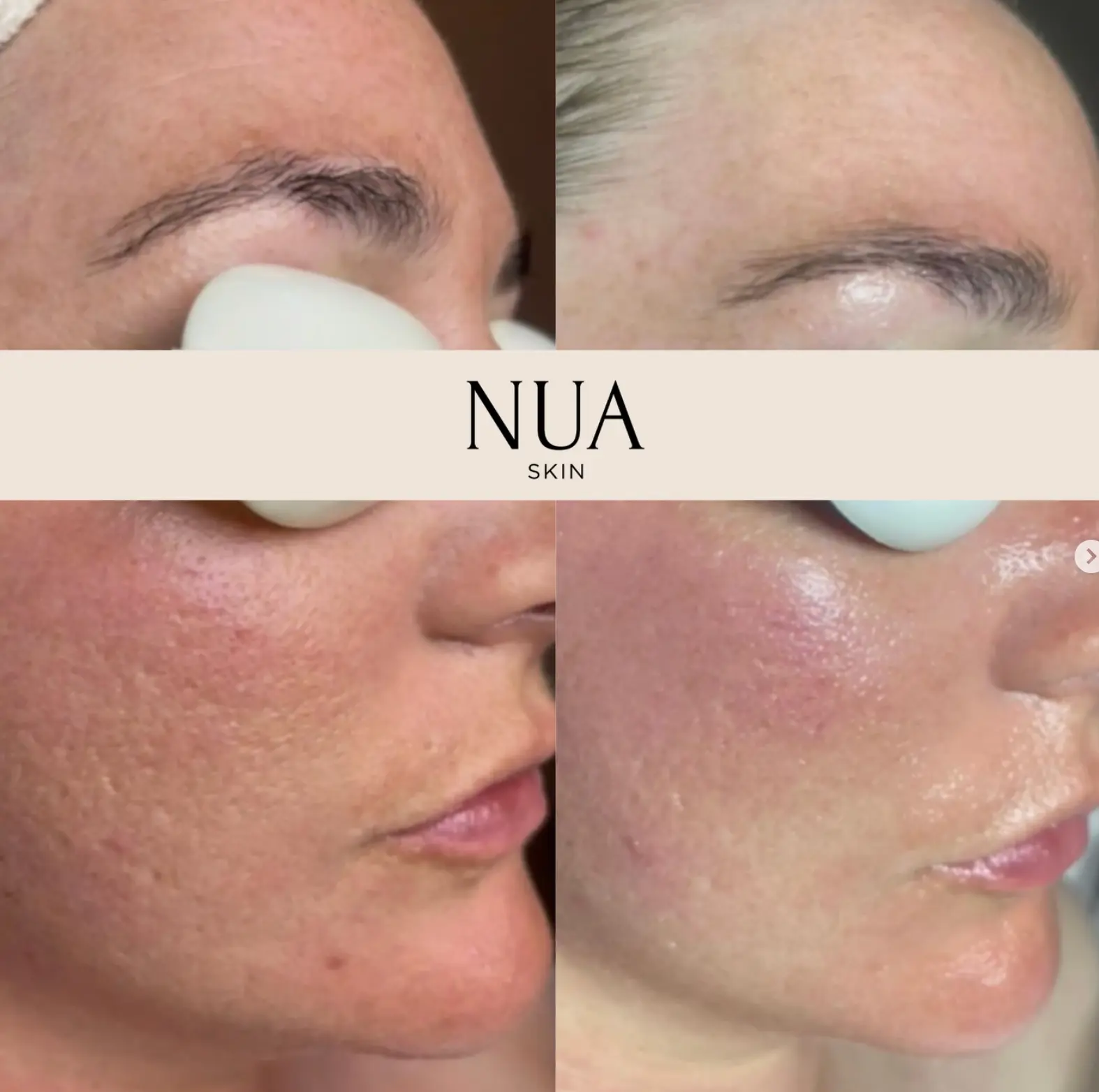 Client skin before and after treatment at Nua Skin, result 3