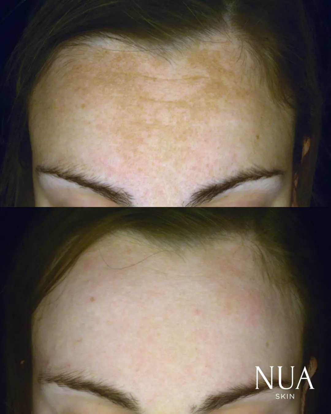 Before and after pigmentation treatment — Freckling & Sun Spots Lightened
