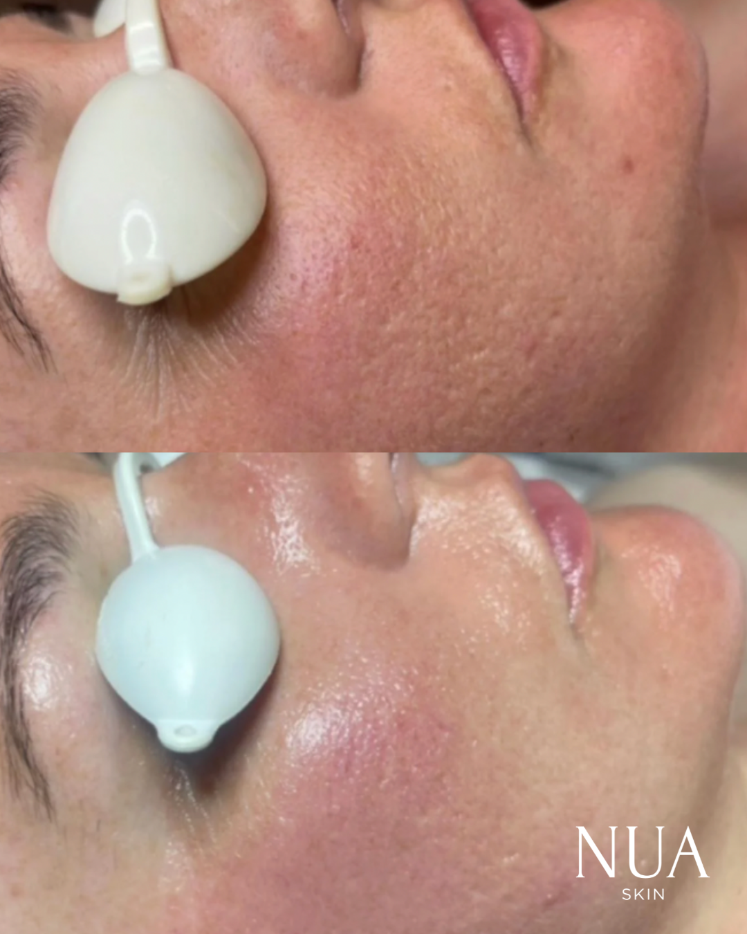 Before and after pigmentation treatment — Even Skin Tone Restored