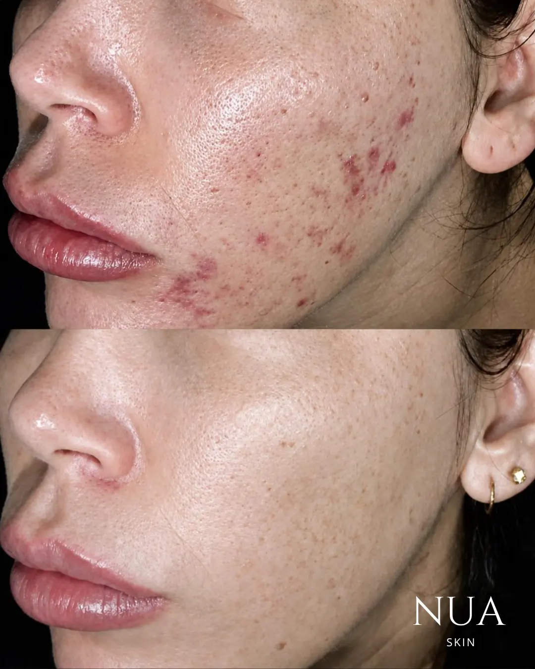 Before and after pigmentation treatment — Post-Acne Marks Faded